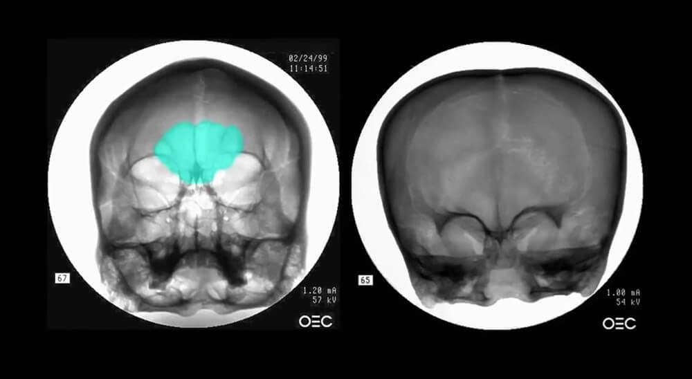 Comparison of the human skull X-ray (left) with a Starchild Skull X-ray (right). There are no visible sinuses. ©History