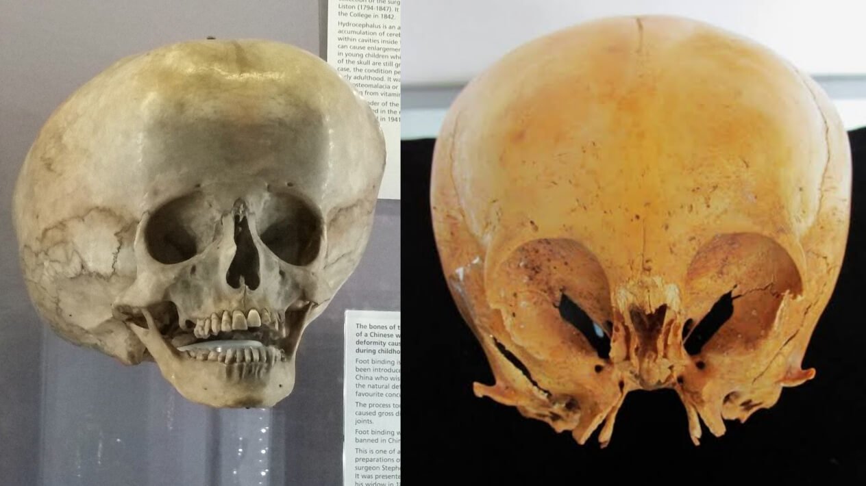 Comparison of a Hydrocephalus Skull (left) with the Starchild skull (right). ©Wikipedia/History
