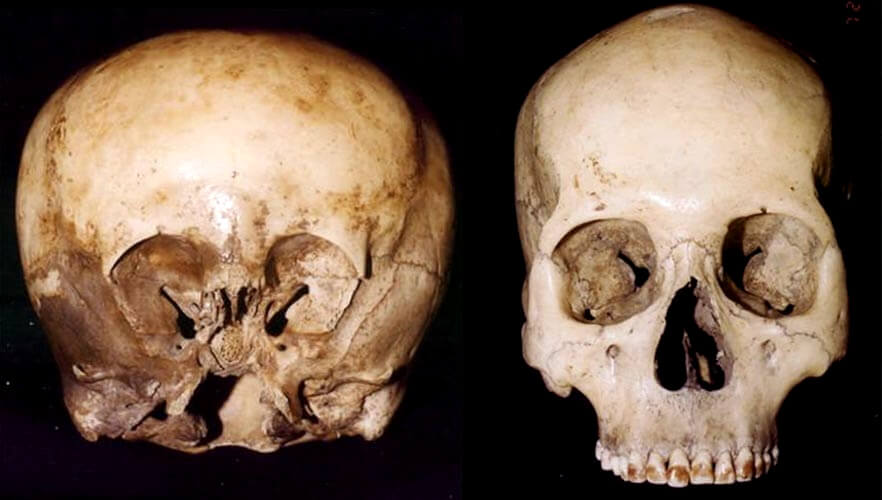Comparison of the Starchild Skull (left) with a human skull (right). The “fibres” and red residue woven in the Starchild Skull’s bone is reminiscent of rebar and increases the strength of the bone by as much as six times stronger than a normal skull. ©History