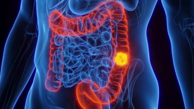 Colon Cancer: New Study Shows Dietary Changes Can Shrink Tumors
