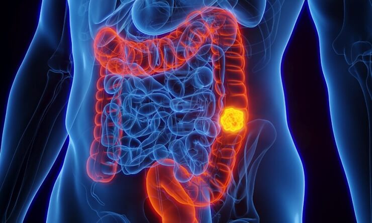 Colon Cancer: New Study Shows Dietary Changes Can Shrink Tumors