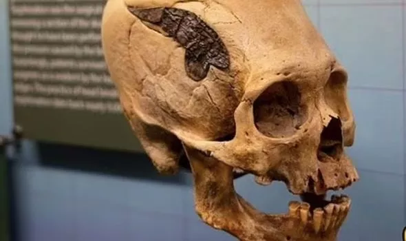 A 2000-year-old skull was bound by metal (Image: Museum of Osteology)