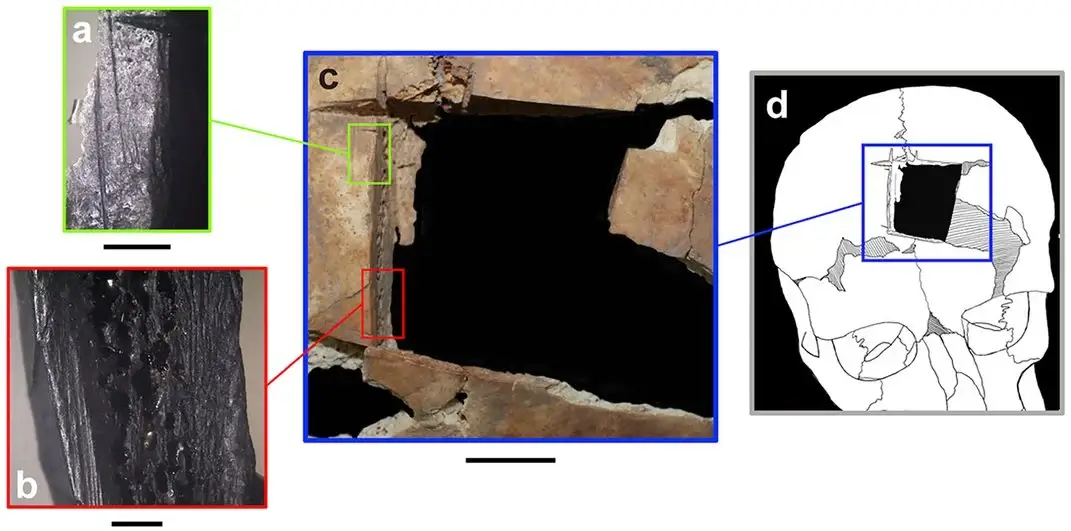 A graphic showing the magnified edges of the affected part of the skull (a, b), all four edges of the trepanation (c) and the location of the opening in the skull (d). Kalisher et al., 2023, PLOS One, CC-BY 4.0