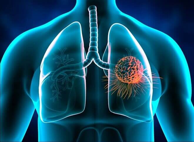 Women Under 50 Are More Likely To Have Lung Cancer Than Men: Study