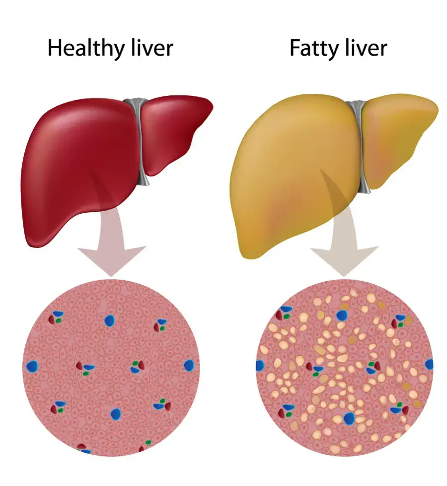 Science Backs It Up: 3 Fruits That Fight Fatty Liver, Regulate Sugar and Cholesterol
