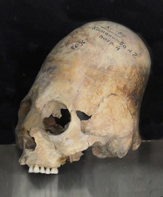 Elongated skull excavated in Samarkand (600–800 CE), Afrasiab Museum of Samarkand